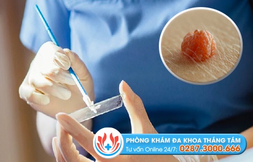 Test sùi mào gà tại nhà