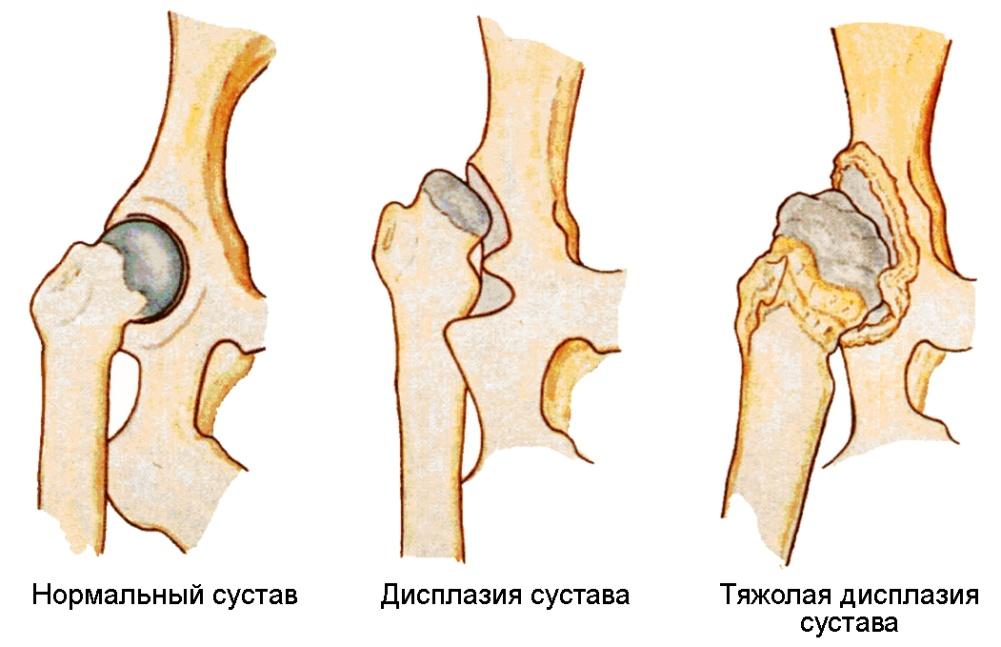 Дисплазия тазобедренного сустава