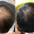 Is seborrheic alopecia also treatable? Is exosome hair growth technology really so amazing?