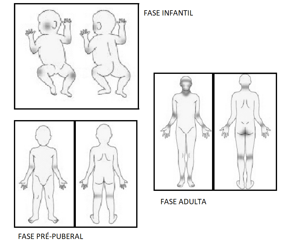 Guia prático para o manejo da dermatite atópica