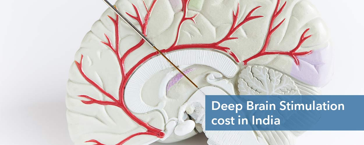 Deep brain stimulation cost India