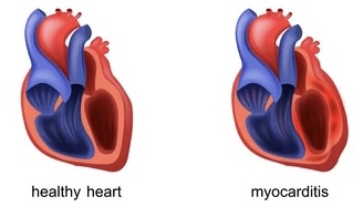 Tradução: "Healthy heart" = Coração saudável / "Myocarditis" = Miocardite.