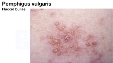PEMPHIGUS vulgaris