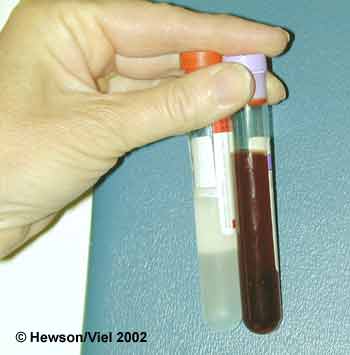 A normal BAL sample is shown on the left, in comparison to BAL fluid from a horse with exercise-induced pulmonary hemorrhage (right).