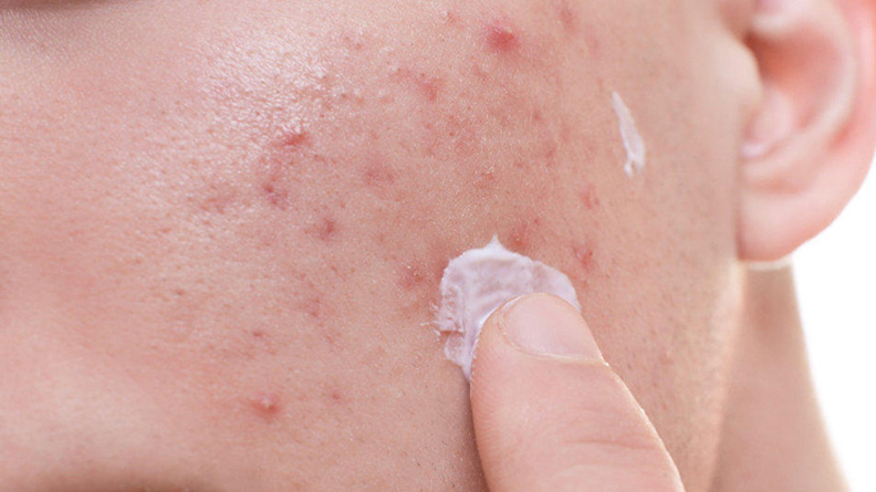 Để loại bỏ mụn trứng cá, bác sĩ thường hướng dẫn người bệnh dùng kem Benzoyl peroxide