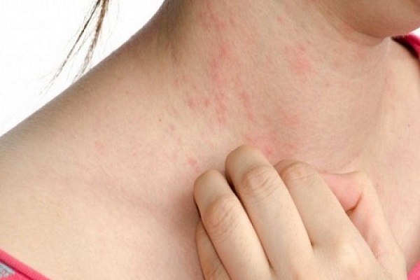 Dị ứng thời tiết là như thế nào?