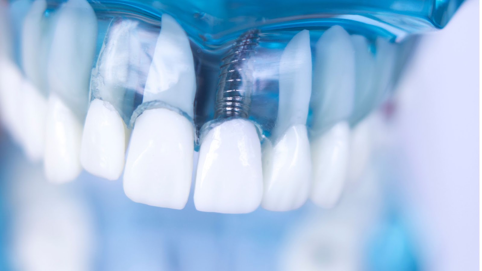 Part 2: How Do I Choose a Great Dental Implant Marketing Company?