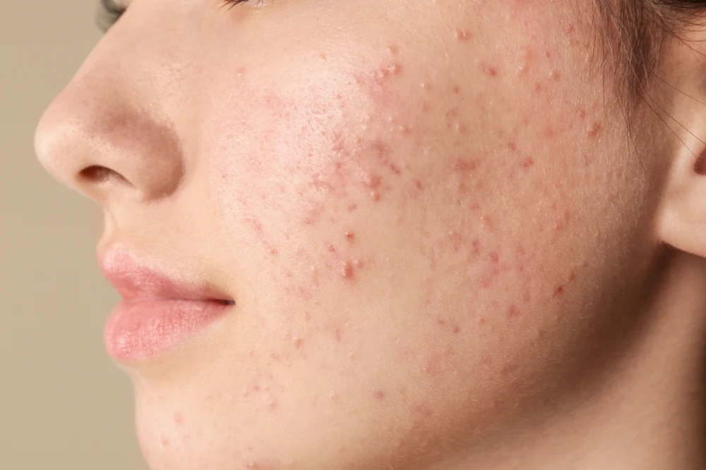 What is the Best Acne Treatment for Sensitive Skin? 4 Best Acne