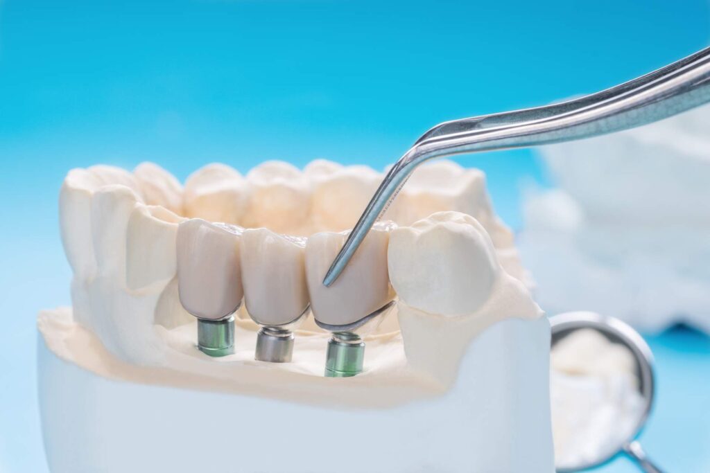 02 Three-dimensional model of human denture prosthesis with implant anchored to the mandible