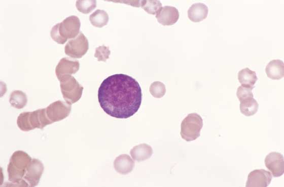 Canine blood. Large blast cell has dark blue cytoplasm, round eccentric nucleus, multiple nucleoli, and focal cytoplasmic clear zone (100x).