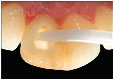 Placing gel in back of tooth