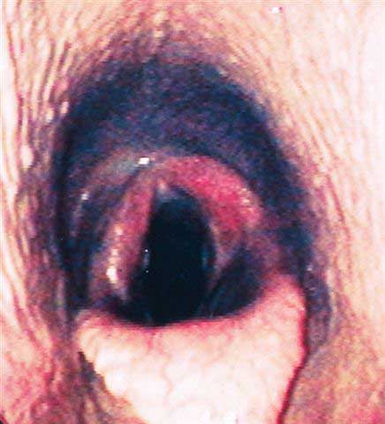 Endoscopic appearance of the larynx following left laryngoplasty. The left arytenoid is in a fixed and abducted position.