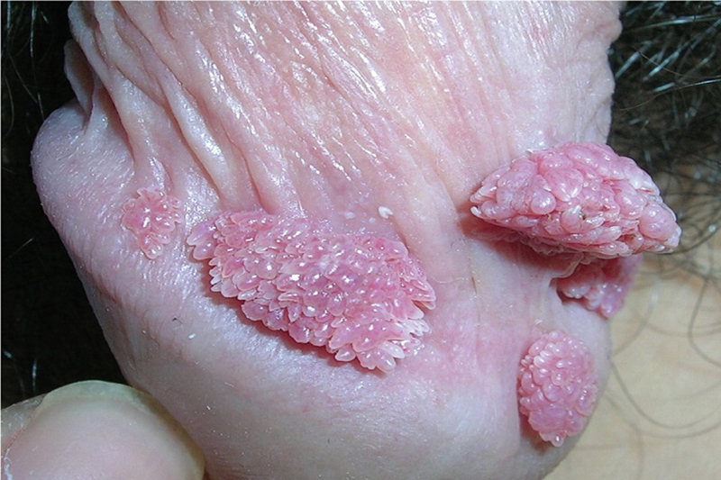 Nguyên nhân gây bệnh Sùi mào gà