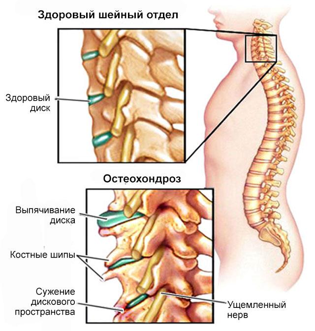 Лечение остеохондроза в Перми