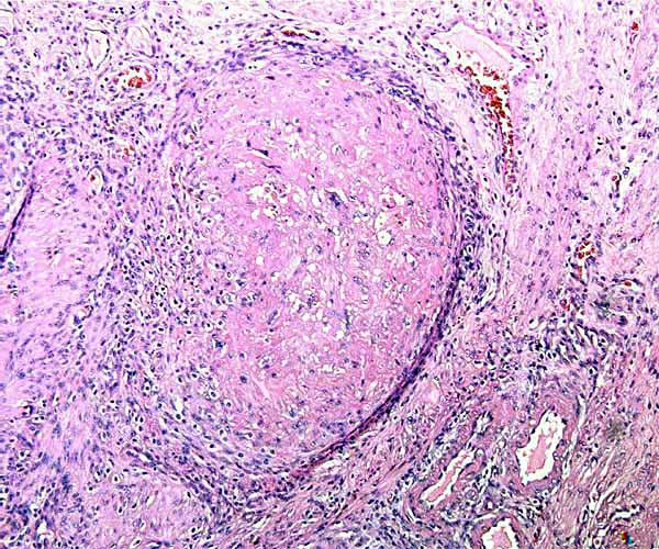 Myometrial artery of post partum uterus is completely filled with persisting, somewhat hyalinized trophoblast. Note the round cells infiltration in the periphery.