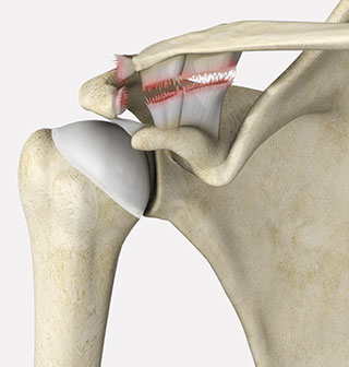 Shoulder Separation showing ligaments of the AC joint are damaged. 
