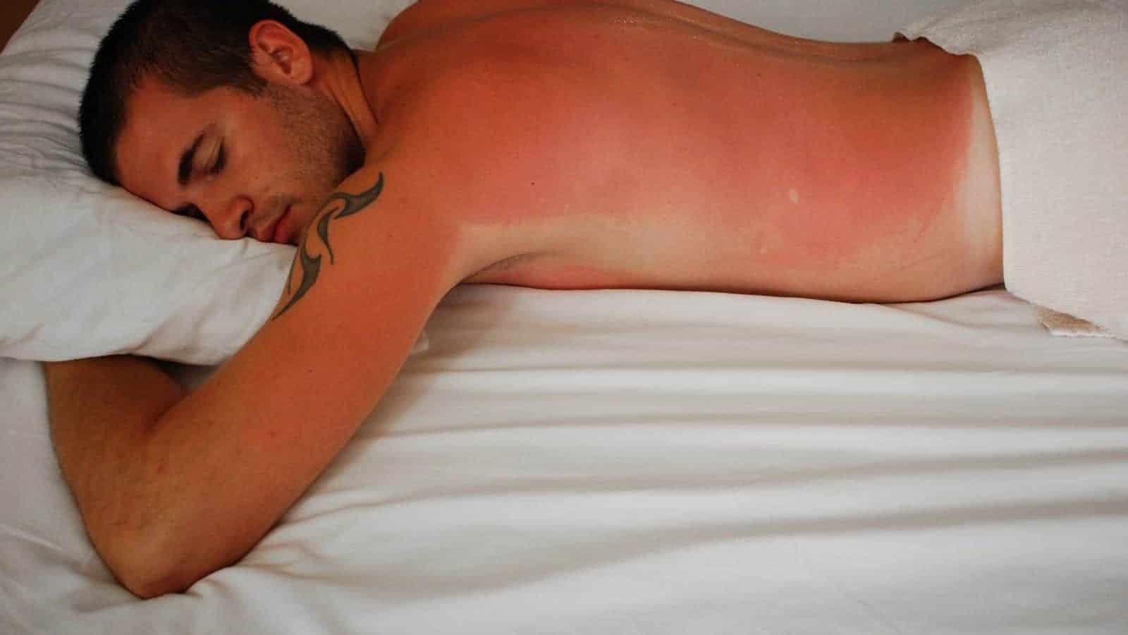 dormir con una quemadura de sol