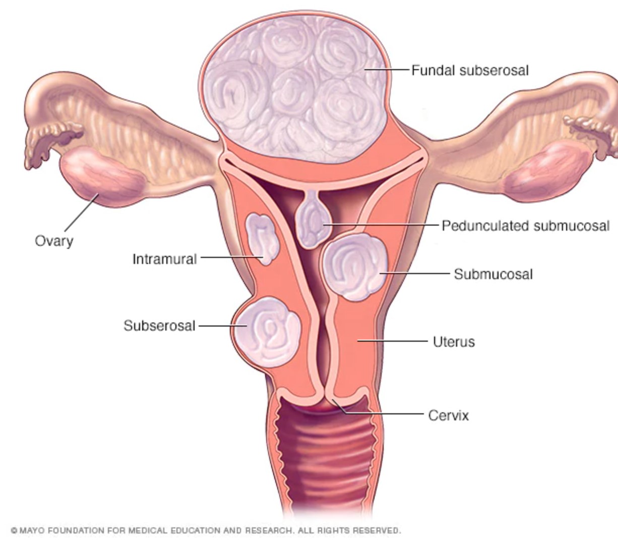 Diagram of the different types and location of uterine fibroids