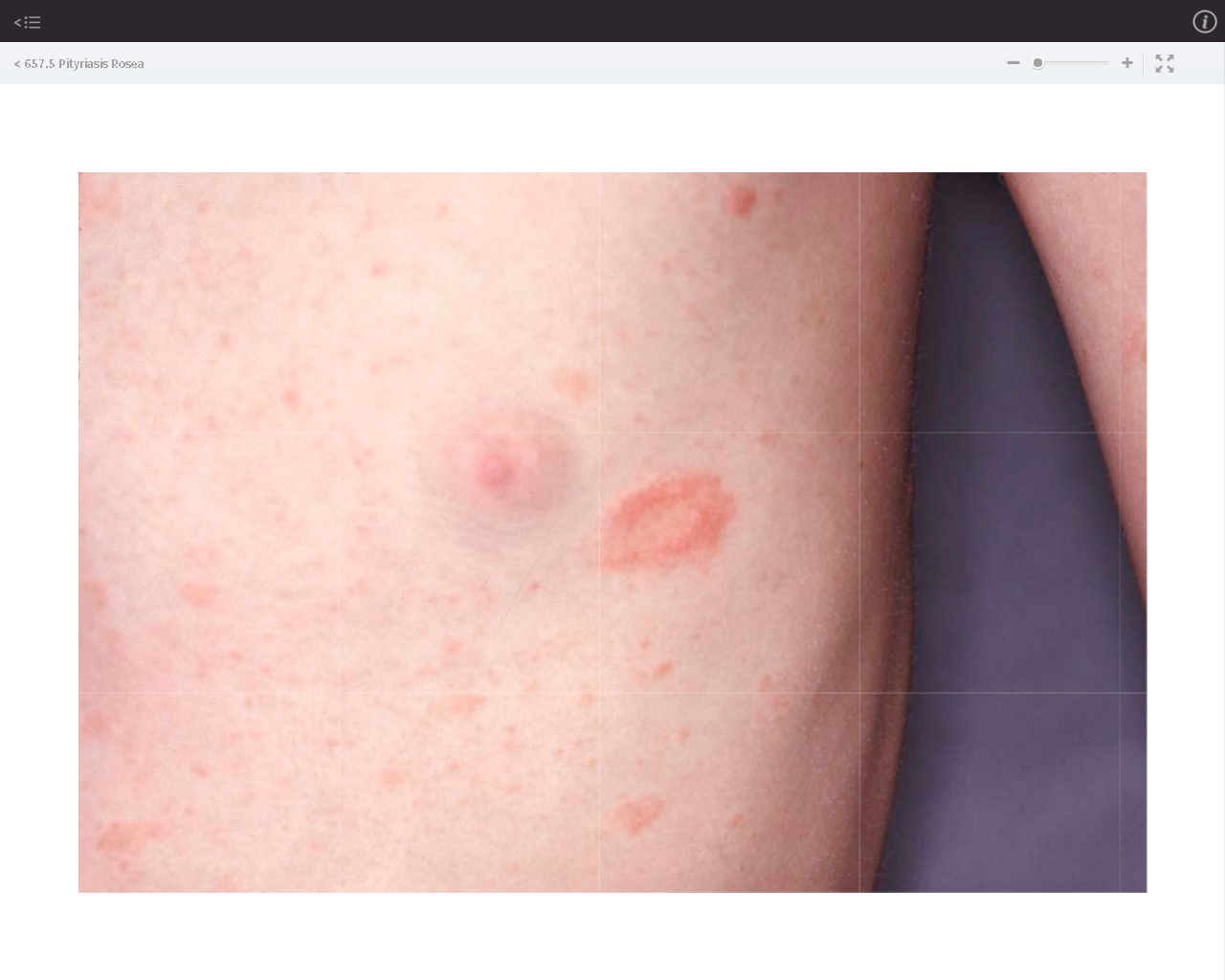 Pityriasis Rosea ("růžová pityriáza")