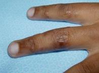 Skin infection pictures and treatments