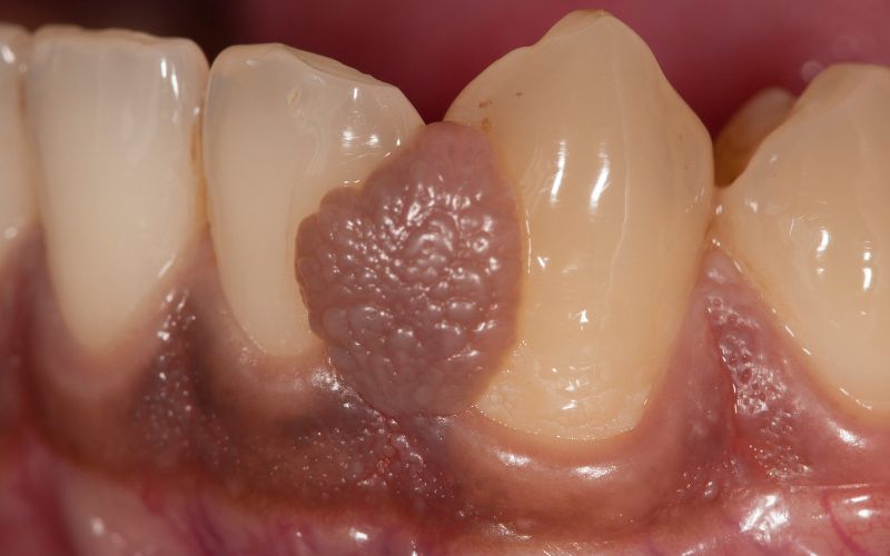 Sưng nướu răng có nguy hiểm không? Nguyên nhân và cách điều trị