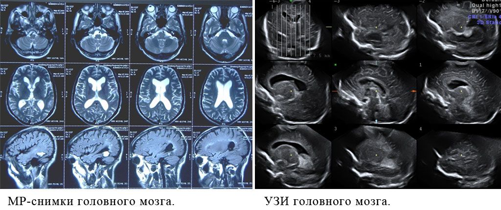 Разница МРТ и УЗИ головного мозга