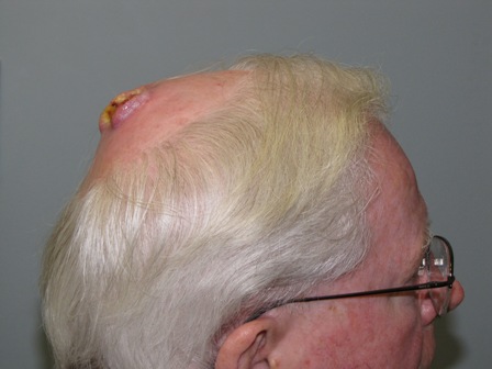 Scalp Carcinoma Treatment