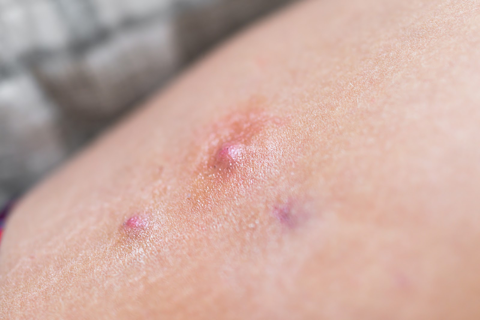 Blemishes on the skin caused by Hidradenitis suppurativa.