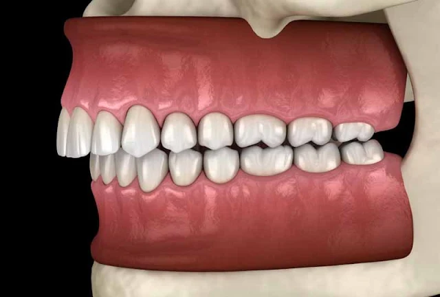 Niềng Răng Khớp cắn sâu
