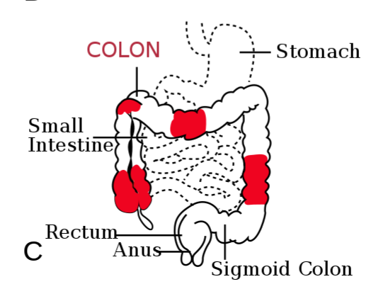 Menú para enfermedad de crohn