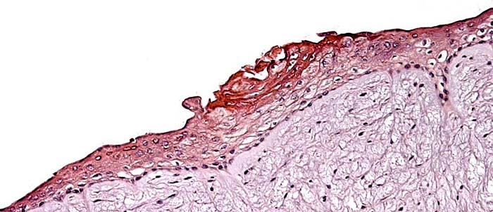 Squamous metaplasia on the surface of the umbilical cord