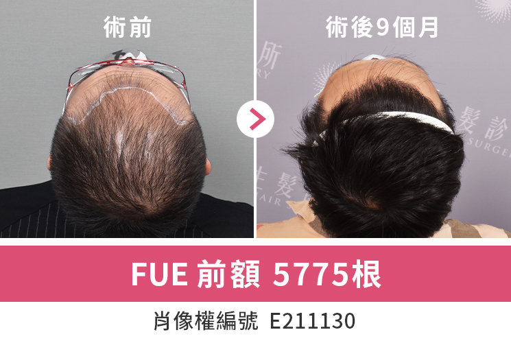 FUE植髮：痛感低、免拆線、精準植髮