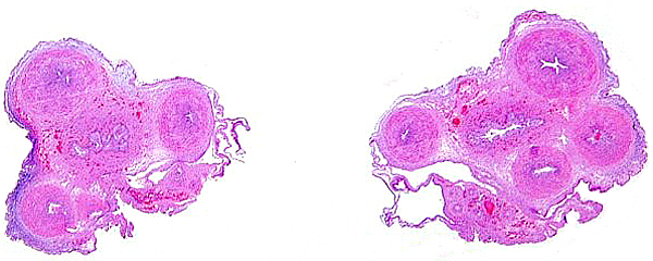 Overview of umbilical cord sections. In the section on the right one large arterial branch is leaving with the membranes to reach the chorion