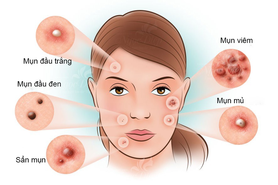 Các loại mụn trứng cá
