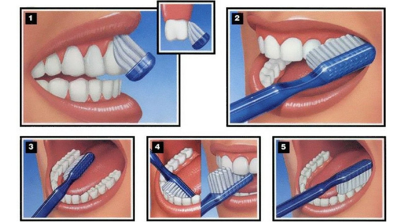 Chải răng đúng cách giúp cải thiện viêm lợi có mủ