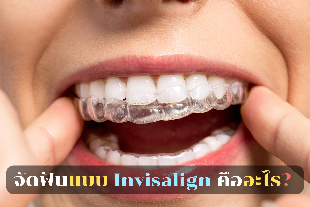 จัดฟันแบบ Invisalign คืออะไร.png