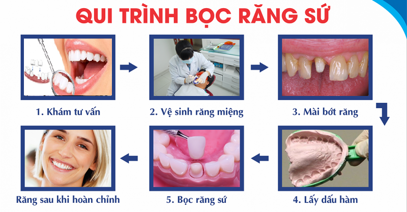 C:\Users\Administrator\Documents\GBVN\09.08.Nha khoa Việt Đức\Bọc răng sứ mất bao lâu\1-800x418.jpg