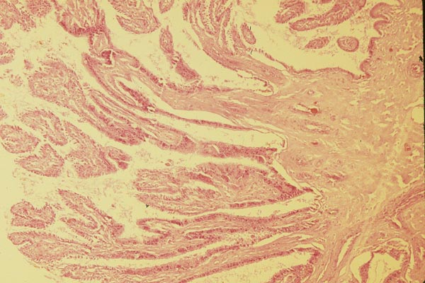 Another view of the placental surface (right) with villous branches extending left