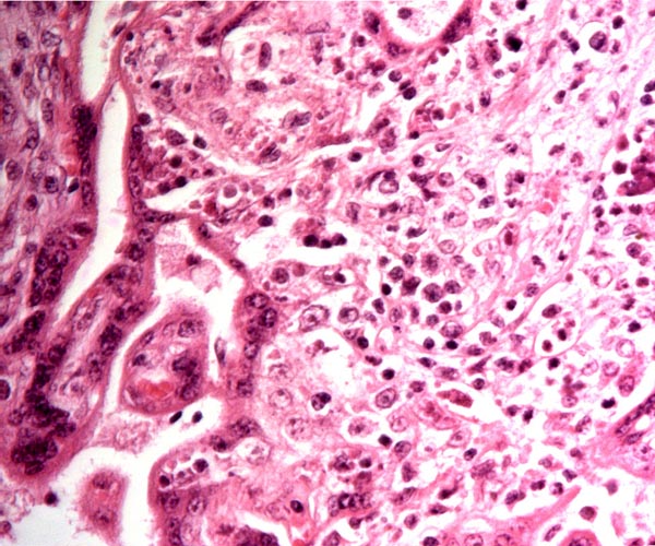 Chronic villitis (infiltration of the villous core with lymphocytes and macrophages)
