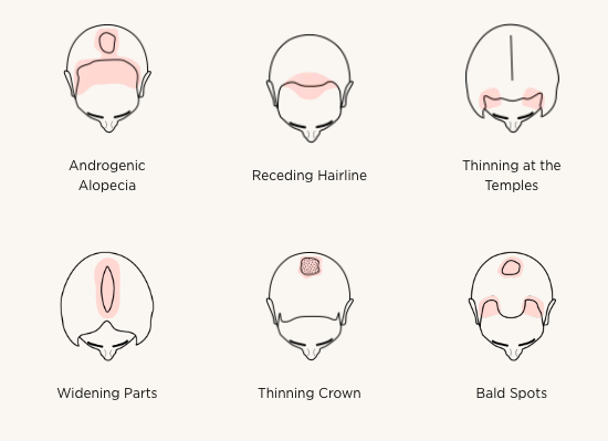 hair loss