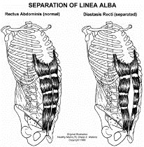 diástasis abdominal.jpg