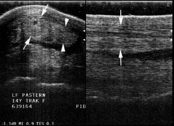 Small core lesion within medial lobe of DDFT in a 14-yr-old Trakhener dressage horse with persistent lameness localized to the pastern region.