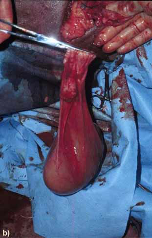 Ovariectomy in a dromedary camel with ovario-bursitis: Resection of the ovary and ovarian bursa in block.