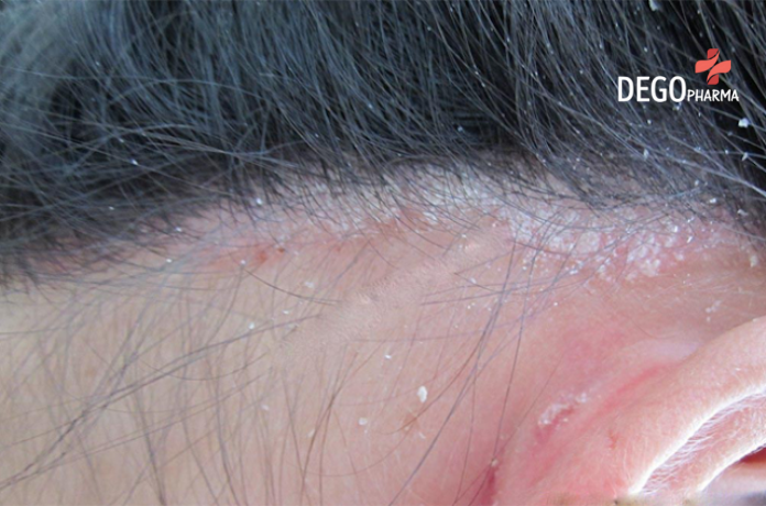  Bệnh vảy nến da đầu có nguy hiểm không? (ảnh minh họa)