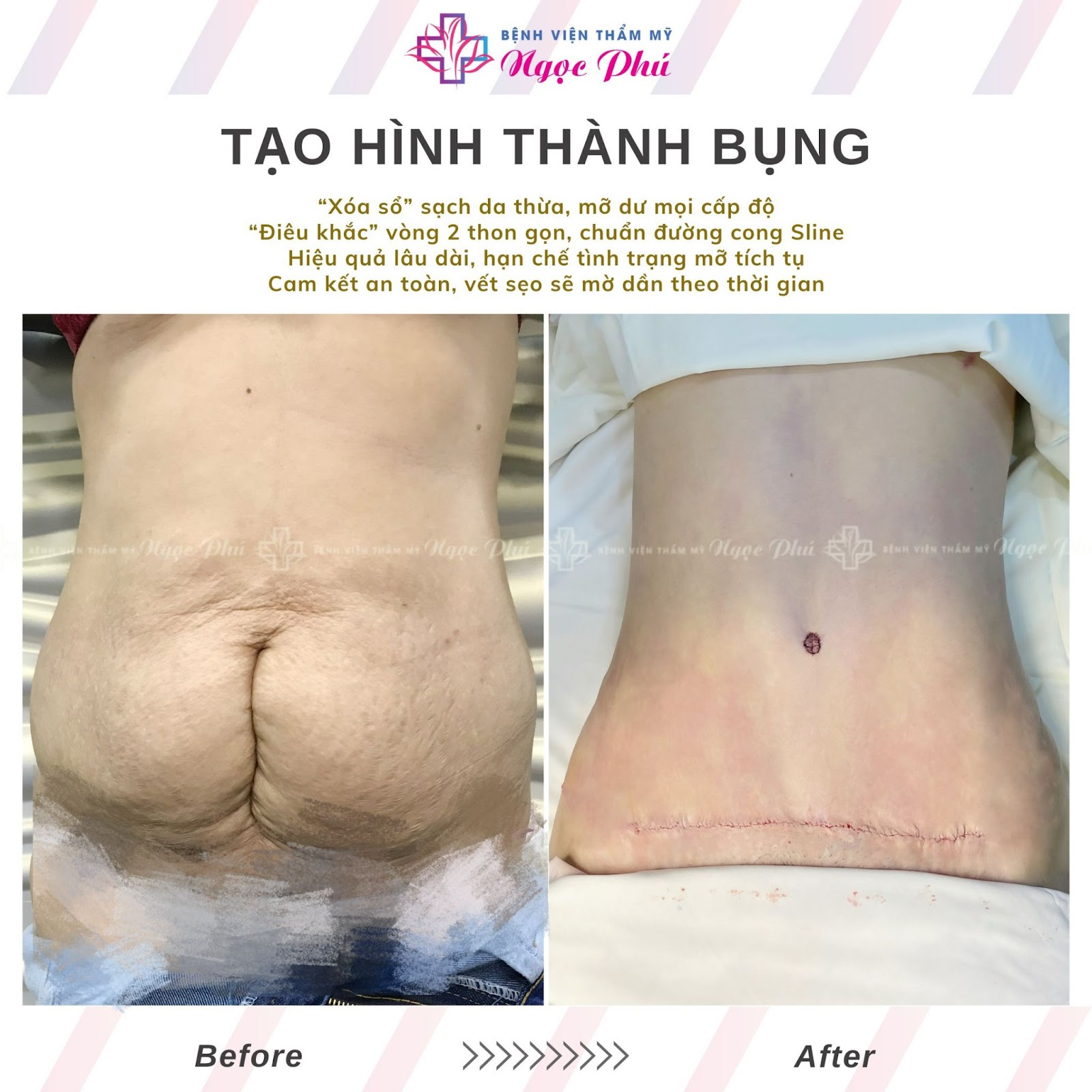 Hình ảnh khách hàng trước và sau khi hút mỡ tại Bệnh viện Thẩm mỹ Ngọc Phú