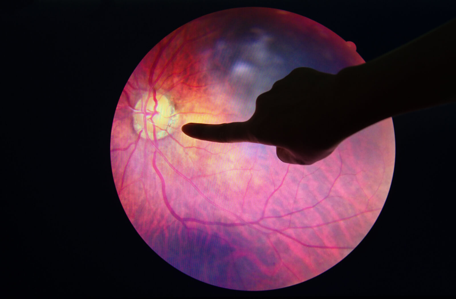 A close-up of a human hand pointing to a growing abnormal blood vessel in the retina.