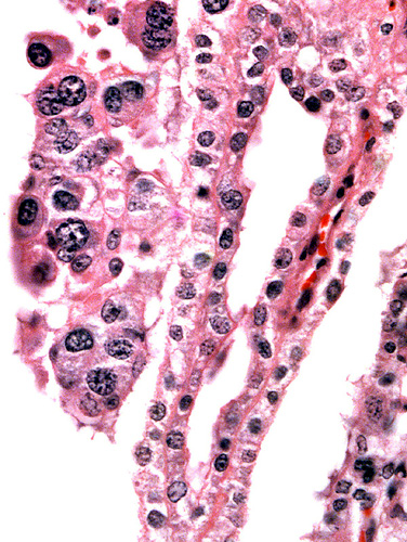 Binucleate cells top left and slender fetal villi of term placentad