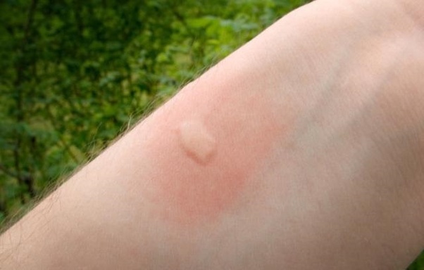 Mosquito bite on the inside of a person’s forearm.