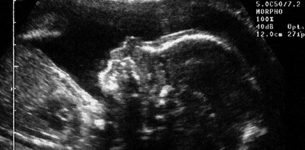 L'échographie, un bon moyen d'annoncer une grossesse (et de ...