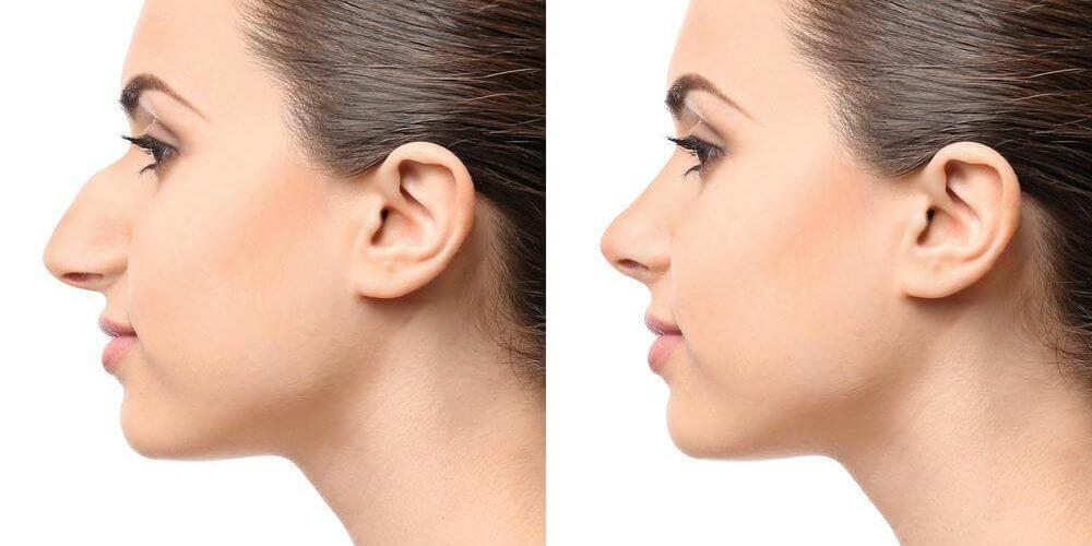 Avant et après une rhinoplastie